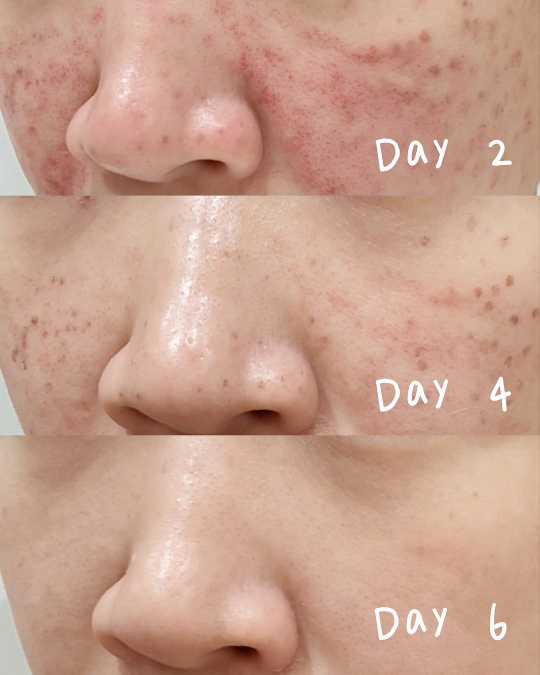 蜂巢皮秒－肌膚新生的七日實錄：見證傷口結痂到磨皮濾鏡的誕生